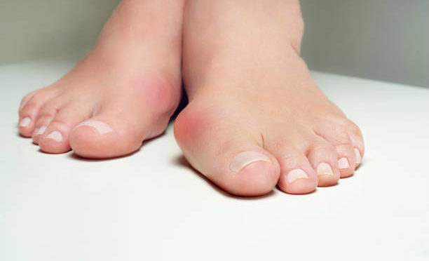 All About Bunions